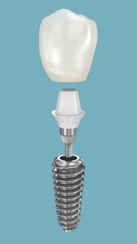 Dental Implants