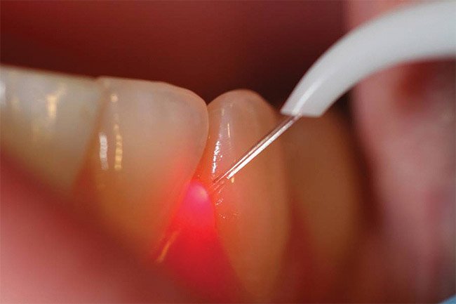 Dental Laser Treatment