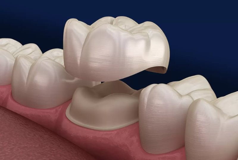 Dental Crowns
