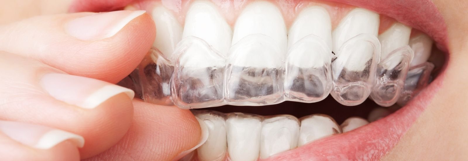 Invisible Orthodontics