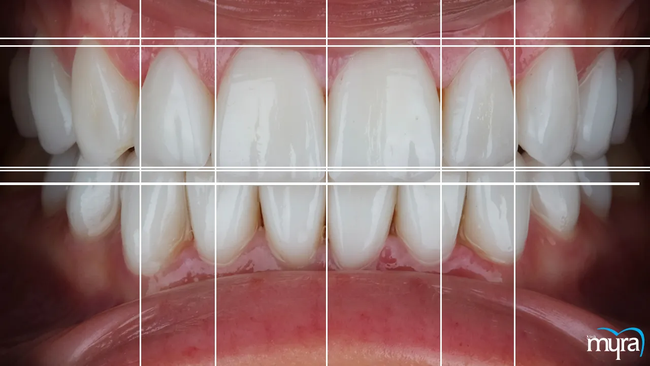 Dental Crowns