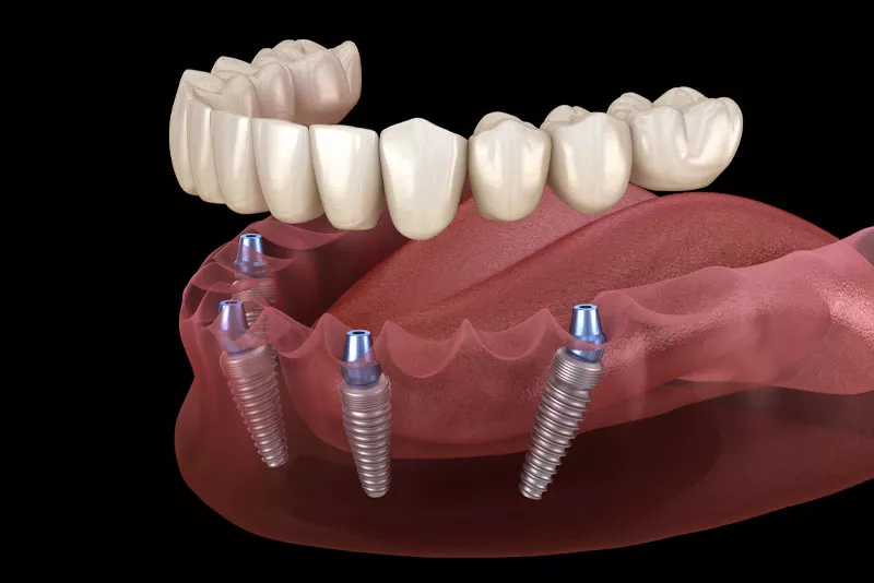 Dental Implant Surgery